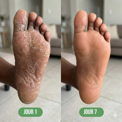 Celneo® – Savon Antifongique